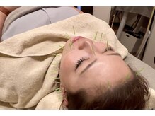 ユー 喜連西店(U)/美容鍼