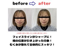 ユー(You)の雰囲気（小顔調整のbeforeafter）