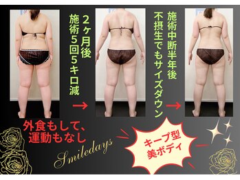 スマイルデイズ(Smiledays)/施術後半年でもリバウンド無し