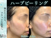 肌のごわつきやざらつきを改善し触れたくなるなめらかな肌へ導きます