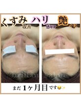 ブレリアントサロン 池袋店(brillant salon)/【施術】年齢肌トータル改善