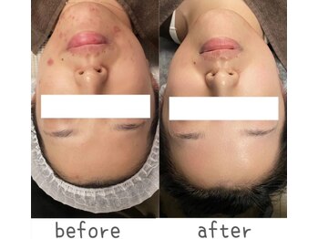 トモズサロン28(Tomos.salon.)/肌荒れ改善！敏感肌にも◎