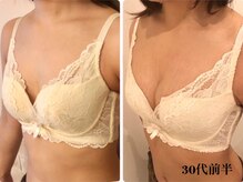 リール 新宿店(RIRE)/30代前半　バストアップ症例