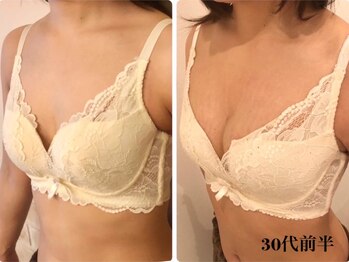 リール 新宿店(RIRE)/30代前半 バストアップ症例