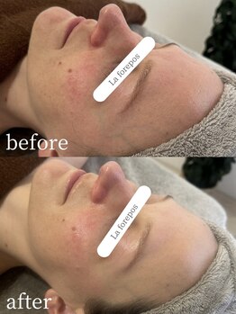 ラ フォルポ 恵比寿(La forepos)/veruna無農薬ハーブピーリング