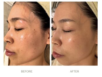 ラシェプリズ(LACHER PRISE)/シミケア・改善例