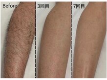 アカヌケ(AKANUKE)/足脱毛