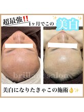 ブレリアントサロン 池袋店(brillant salon)/【施術】年齢肌トータル改善