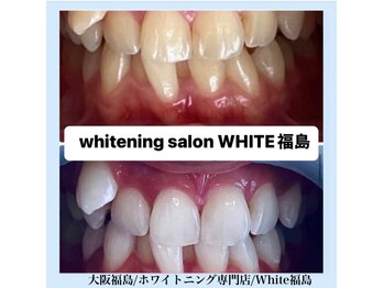 ホワイトニングサロン ホワイト(WHITE)/セルフホワイトニング/大阪/福島