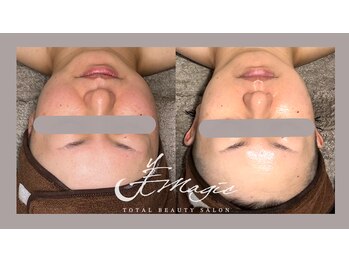 ビーマジック(美magic)/ララピール＋アクアダーマ症例