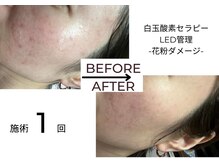 ベガ(Vega)/白玉酸素セラピーLED