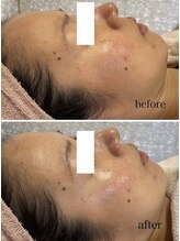 ジェイ(J)/ララピール☆1回でくすみゼロ！