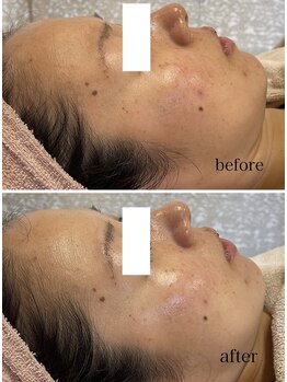 ジェイ(J)/ララピール☆1回でくすみゼロ！