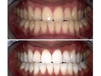 ホワイトサロン/スピードホワイトニングで1日