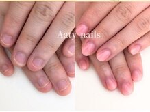 アーティネイルズ(Aaty Nails)/【深爪矯正】ハンド