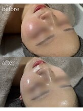 サロンナナジュウニ(Salon72)/くすみ/水光肌