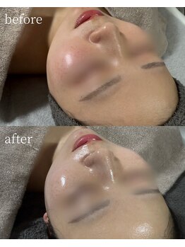 サロンナナジュウニ(Salon72)/くすみ/水光肌