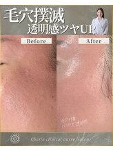 シェリー(Cherie)/【インセルダム】毛穴ケアツヤUP