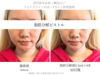 サボラミ(sabor A Mi)/Vライン形成にもオススメ♪