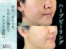 凹凸や肌荒れを整えクリアで均一な美しい素肌へ導く施術です
