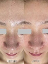 サロンドジェシカ(salon de Jessica)/プラズマ+毛穴洗浄