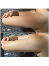 ラクラク(rakuraku)/上半身痩身（二の腕）