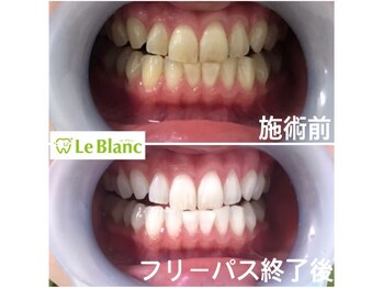 ルブラン 奈良店(Le Blanc)/歯茎もとっても大事です！