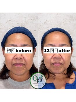 キュープ 相模原淵野辺店(Qpu)/たった4回で人生で1番小さな顔に