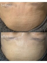 サロンナナジュウニ(Salon72)/シワ/たるみ