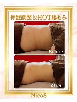 ニコエイト(Nico8)の写真/【内側から美しく】ぽっこりお腹や冷え、むくみの原因は「腸の冷え」と「骨盤の歪み」による内臓下垂かも！