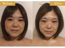 モモスパ(MOMOspa.)/頭蓋骨小顔矯正ビフォアフター