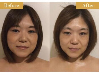 モモスパ(MOMOspa.)/頭蓋骨小顔矯正ビフォアフター