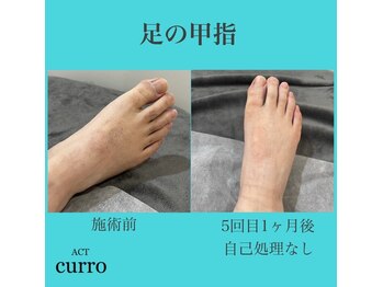 アクト クロ(ACT curro)/【足の甲指】脱毛施術例