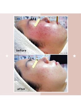 レゾン 京橋店/【ビフォーアフター】ニキビケア