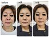 韓国美容☆レモンボトルフェイシャル[小顔・毛穴・くすみ除去]5回+ホームケア
