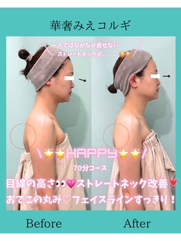 アコガレコガオ 鳥取店/コルギのビフォーアフター