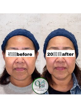 キュープ 相模原淵野辺店(Qpu)/たった4回で人生で1番小さな顔に