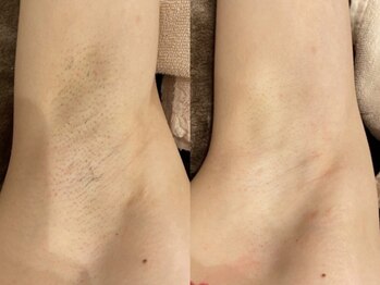 アヴェーラ(Avela)の写真/＼12周年祭限定／【全身(VIO込)＋顔脱毛1回￥5,980】4月周年祭限定♪《¥1,200オフ》でお得に美肌をGET★