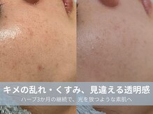 ラシック 加古川店(La chic.)/肌トーンを上げる集中肌育ケア