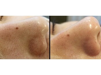 スター 新宿 新宿御苑(★STAR)/施術中メンズアイブロウWAX/新宿