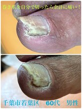 巻き爪じゅん 船橋店/巻き爪を自分で切ったら余計痛い