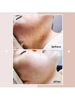 レゾン 京橋店/【ビフォーアフター】ニキビケア