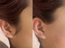 アルム(a'lm)/もみあげワックス脱毛★顔脱毛