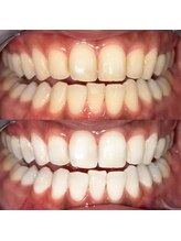 アガリア(agalia)/セルフホワイトニング