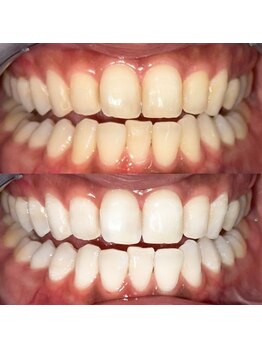 アガリア(agalia)/セルフホワイトニング