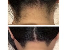 アドビューティ(Add Beauty)/花嫁様プラン／ブライダルエステ