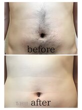 ピーチベル 美濃加茂店(PeachBell)/男性腹脱毛