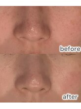 ラキア 五位堂駅前店(Ra kia)/毛穴ケア