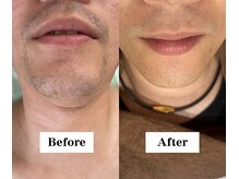 ワイイーサロン(Y/E SALON)/【30代男性　顔脱毛】