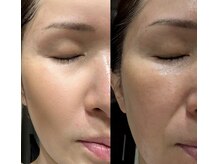 ララピールで毛穴・くすみ・たるみ改善50代からの肌変化に特化